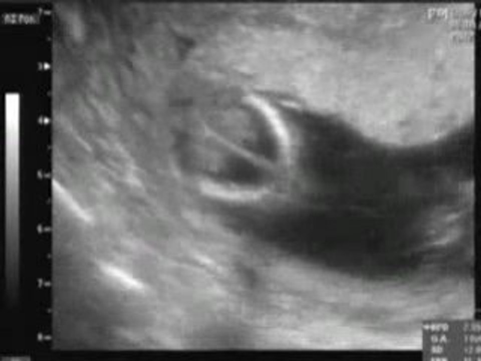 Echographie I