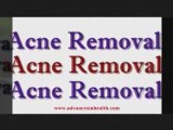 acne zit popping does not work as a acne treatment