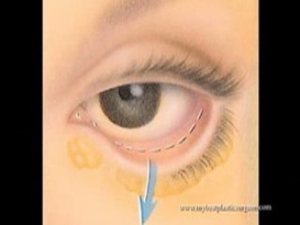 Dr. Warren Lent explains blepharoplasty