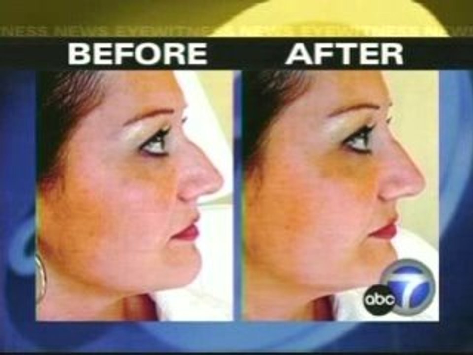 Non Surgical Rhinoplasty-Dr Alexander Rivkin in Los Angeles