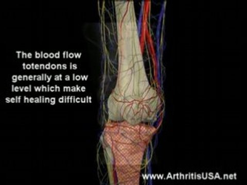 Dr Farshchian s Regenerative Medicine and Jumper's Knee