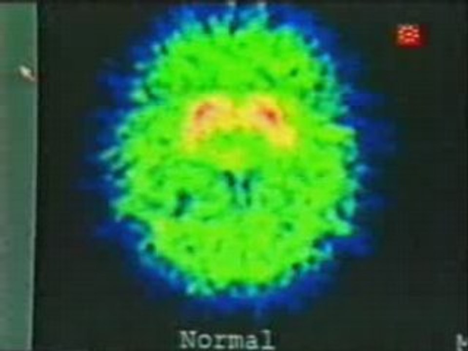 MPTP (7): El resultado