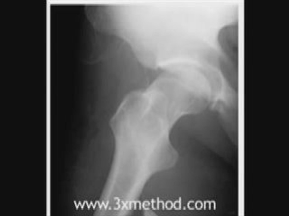Testosterone for Your Bones