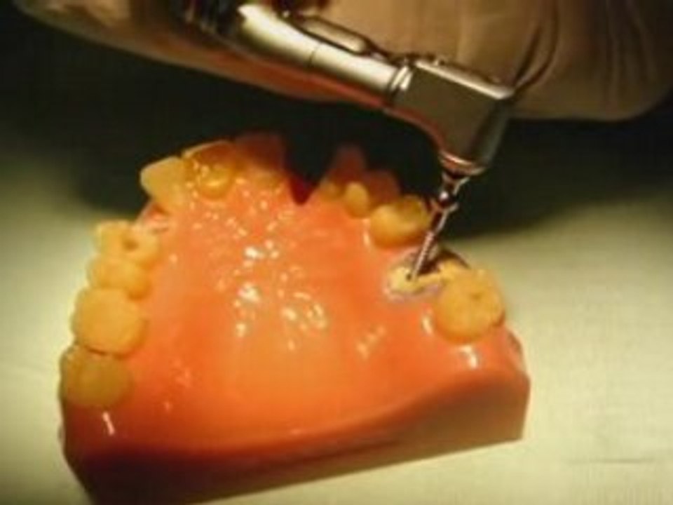 Sapian root removal