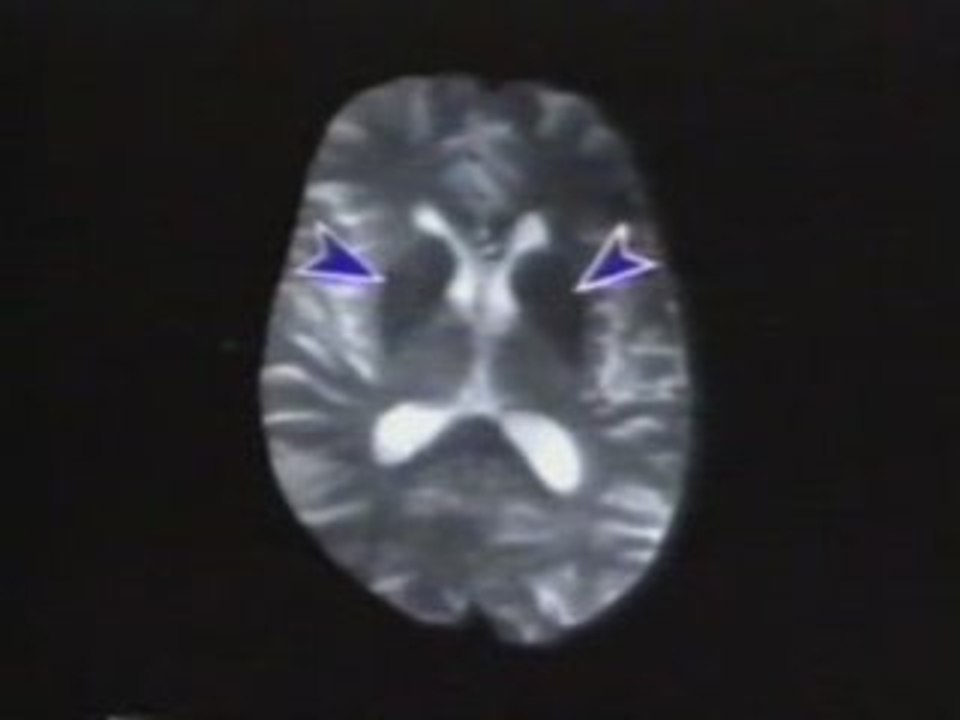 Parkinson: PET y trasplante de celulas fetales