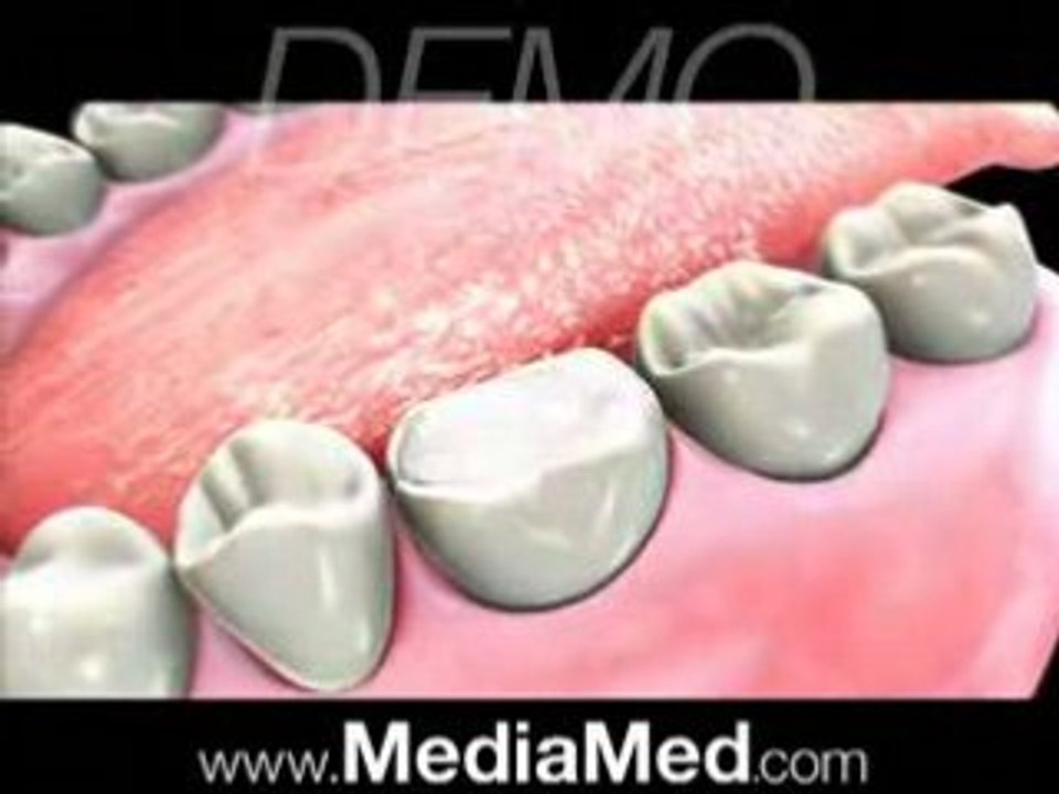 Root Canal-Dental