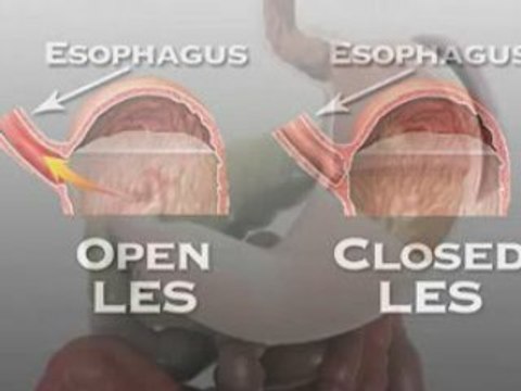 Acid Reflux Symptoms Magnifying Acid Reflux