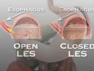 Acid Reflux Symptoms Magnifying Acid Reflux