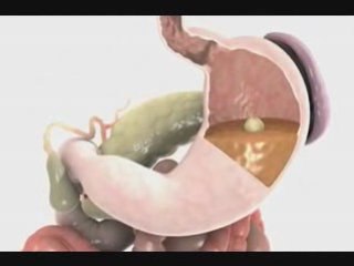 Natural Acid Reflux Tips