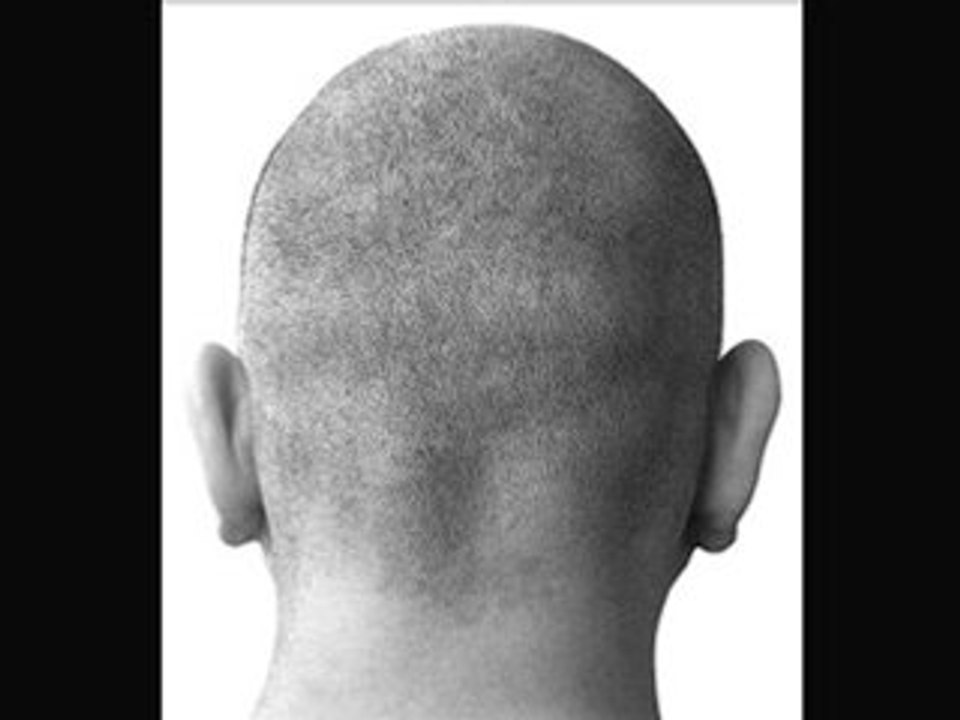 All the information on this great hair loss treatment