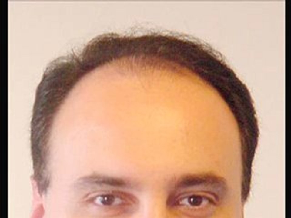 Your search for the best hair loss remedy has ended!