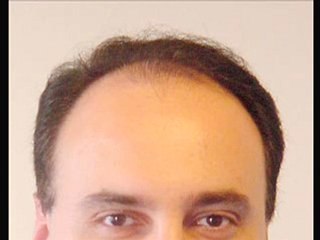 Your search for the best hair loss remedy has ended!