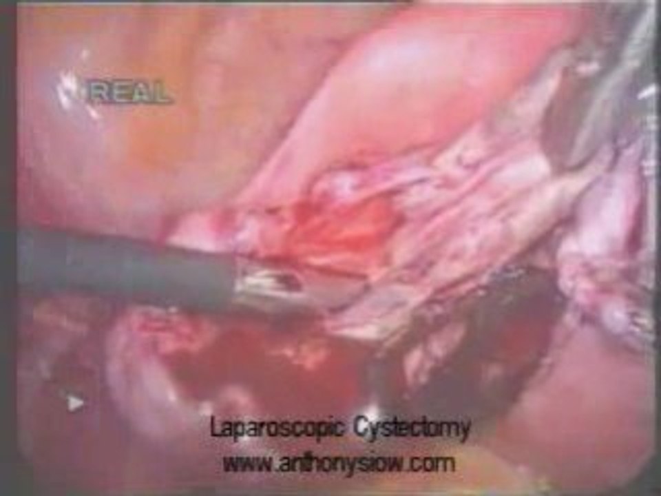 Ovarian cysts no more review
