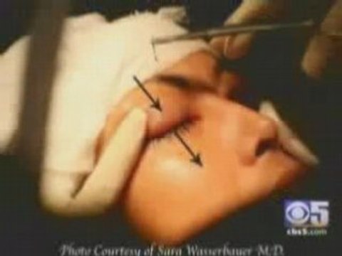 California Surgeon Performs Eyelash Hair Transplants