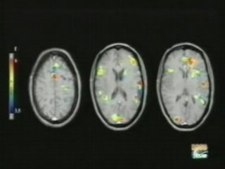 Fibromialgia y cerebro