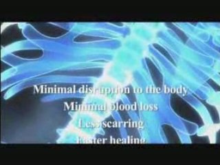 Bulging disc surgery from Bonati