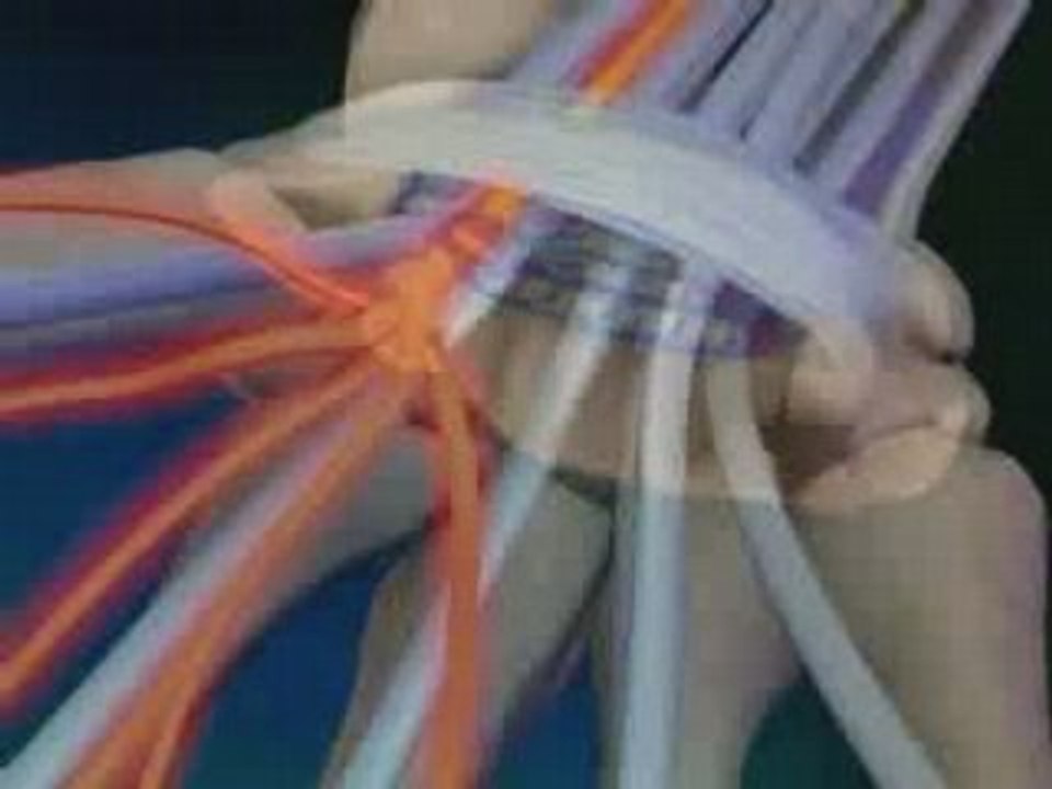 Carpal Tunnel  Syndrome