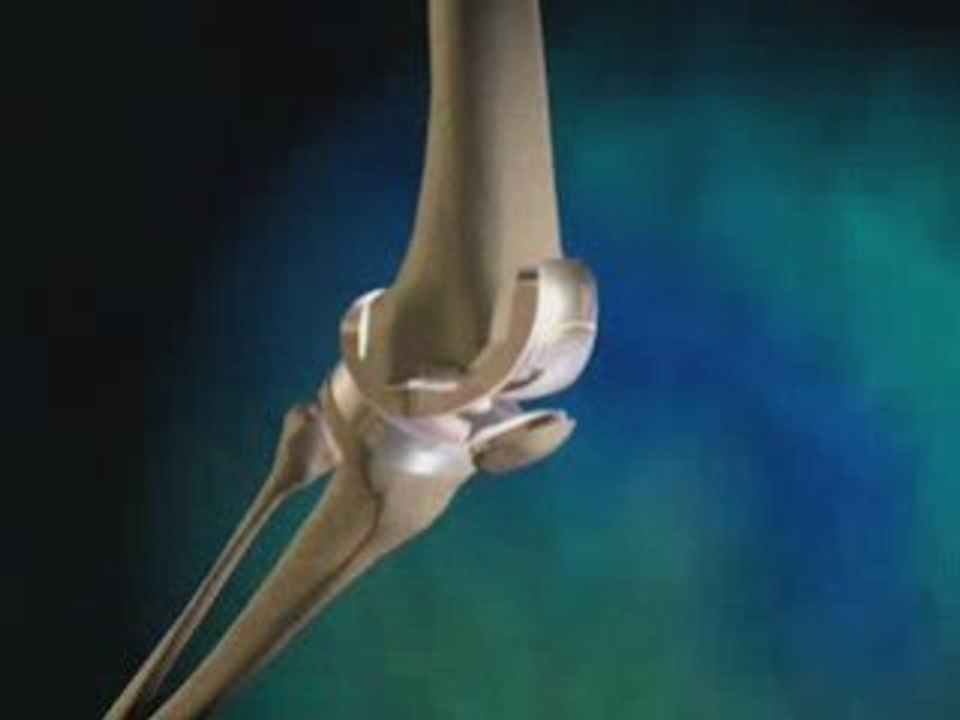 Knee Replacement