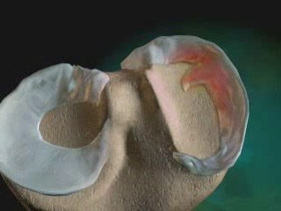 Medial Meniscus Injury