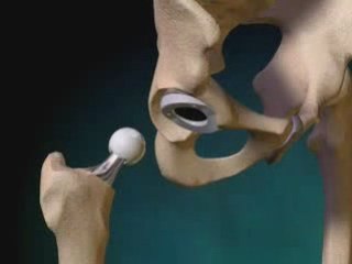 Hip replacement