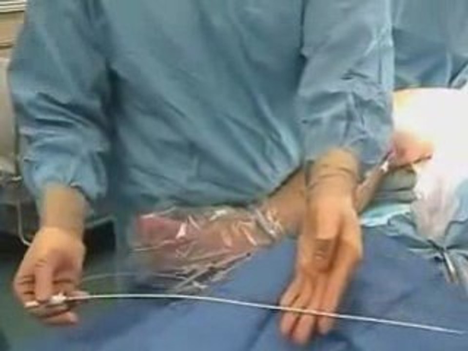 Important Facts About Laser Varicose Vein Removal