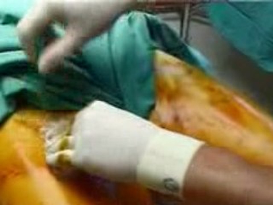 Liposuction - The Aesthetic Surgery Centre in Sydney