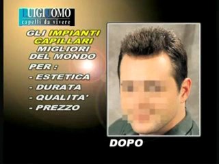 Soluzione definitiva alla Alopecia http://www.luigiuomo.com