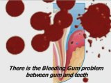 swollen gums,gingivitis treatment,periodontal gum disease