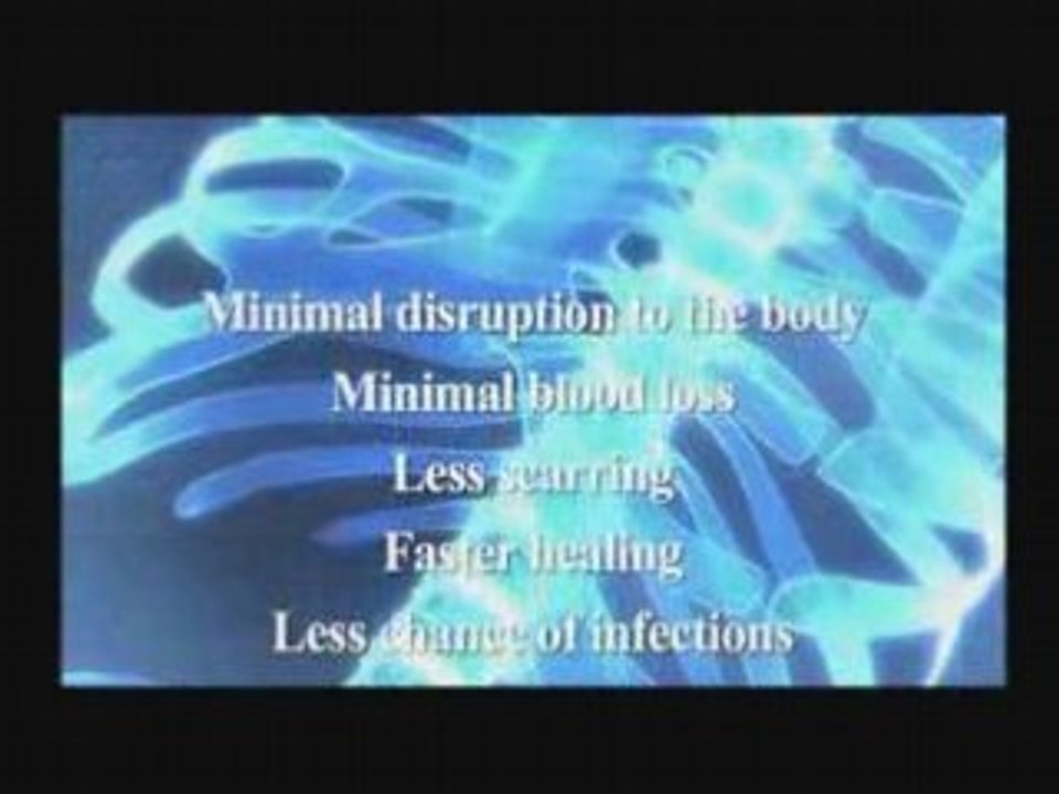 Surgery for spinal stenosis from Bonati