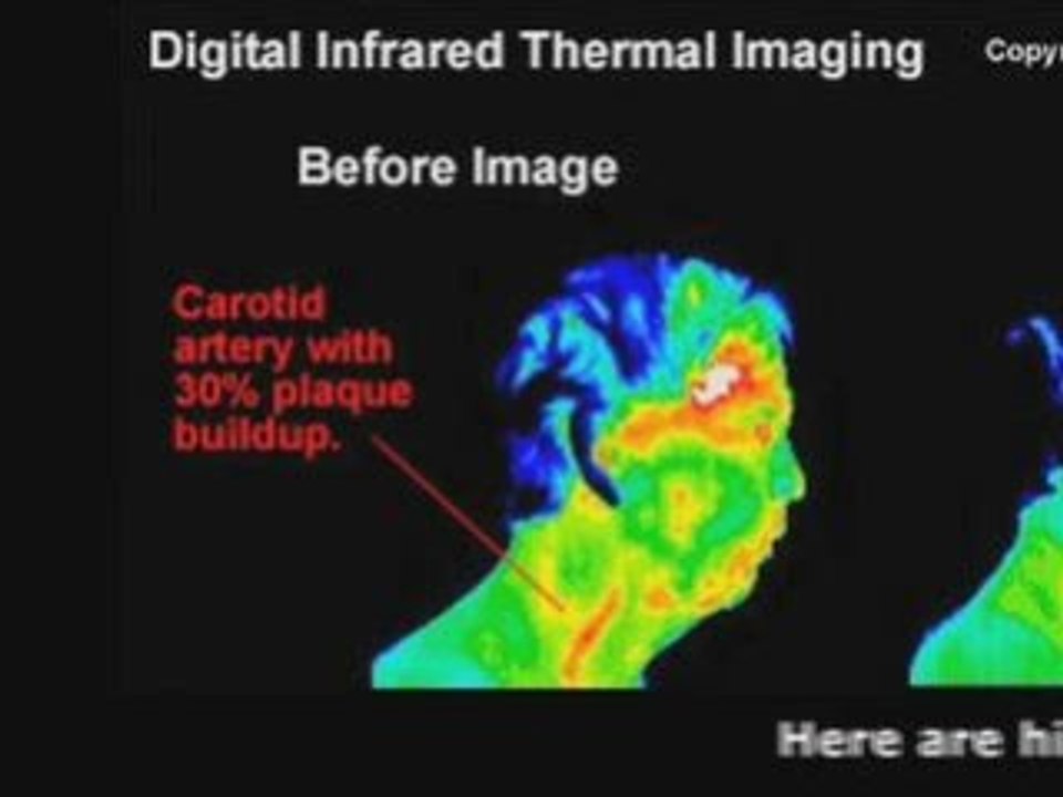 Symptoms of Clogged Arteries