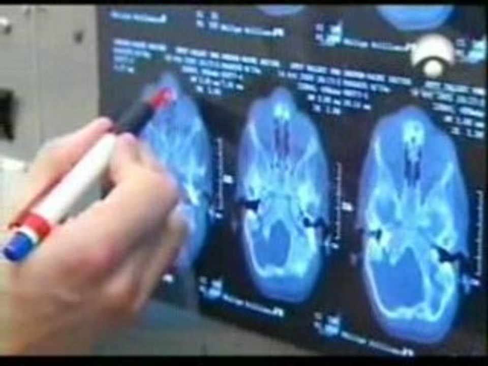 Quiste dermoide nasoetmoidal (Caso Clinico)