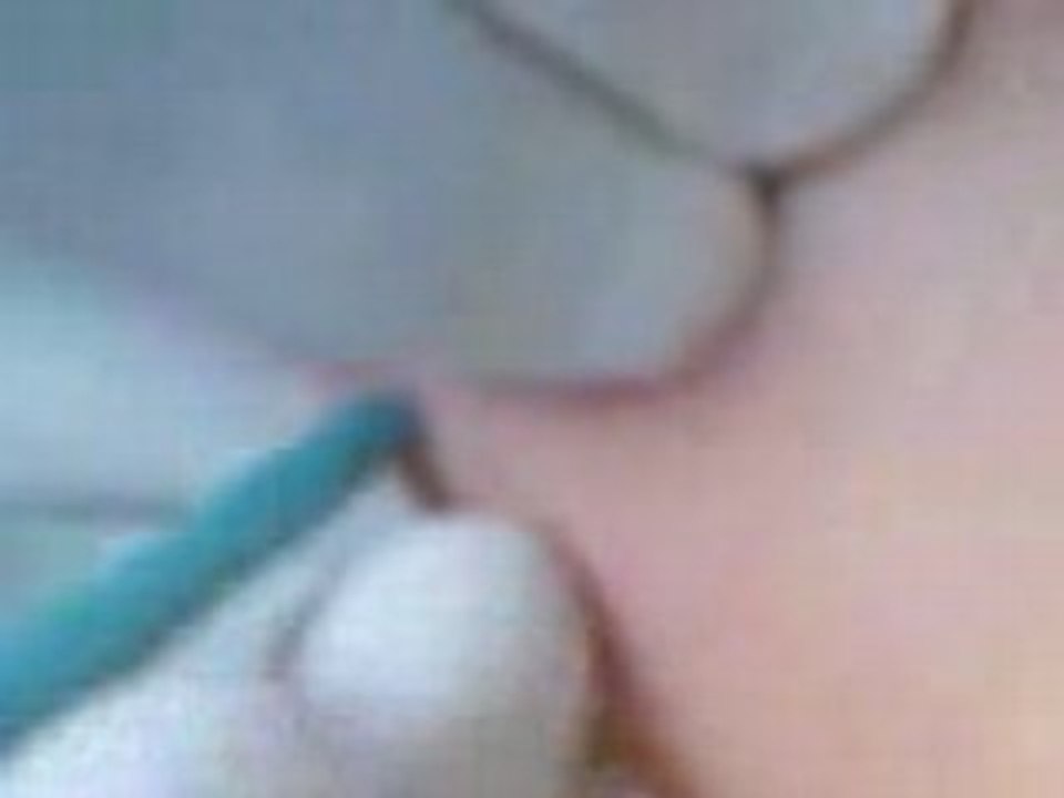 implant transdermique APK