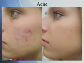 Can Vitamins Cure Acne?