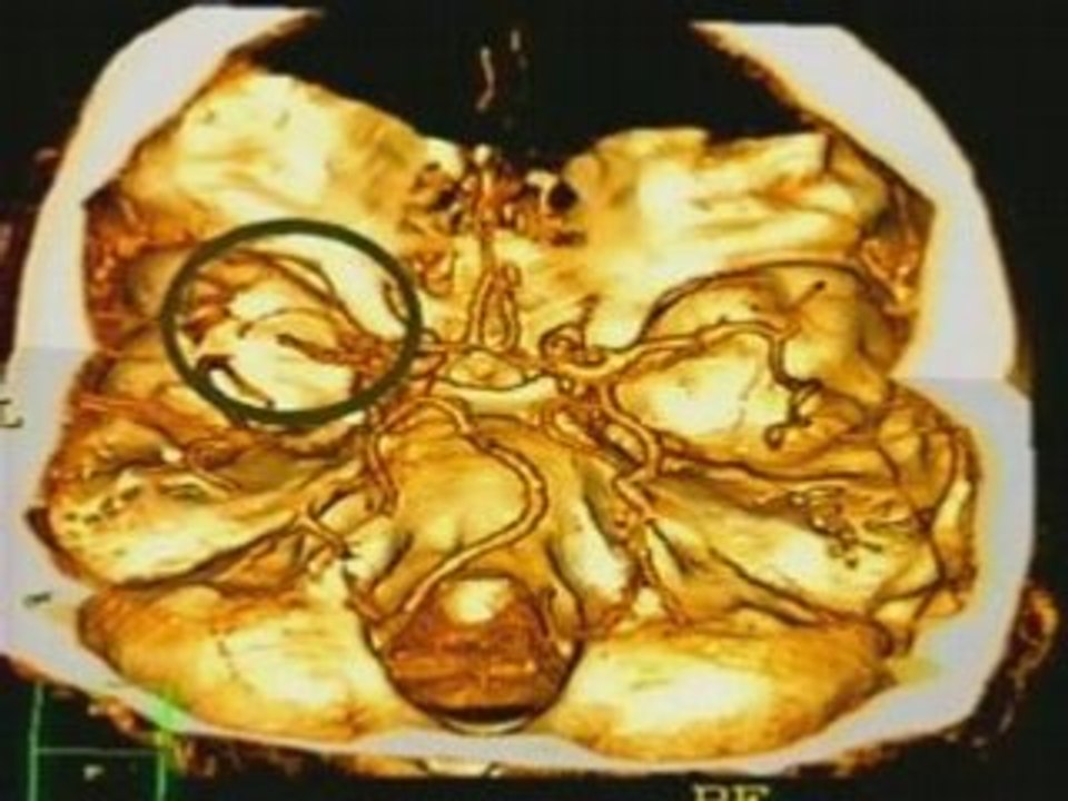 Advances in Stroke Care (Part 2)