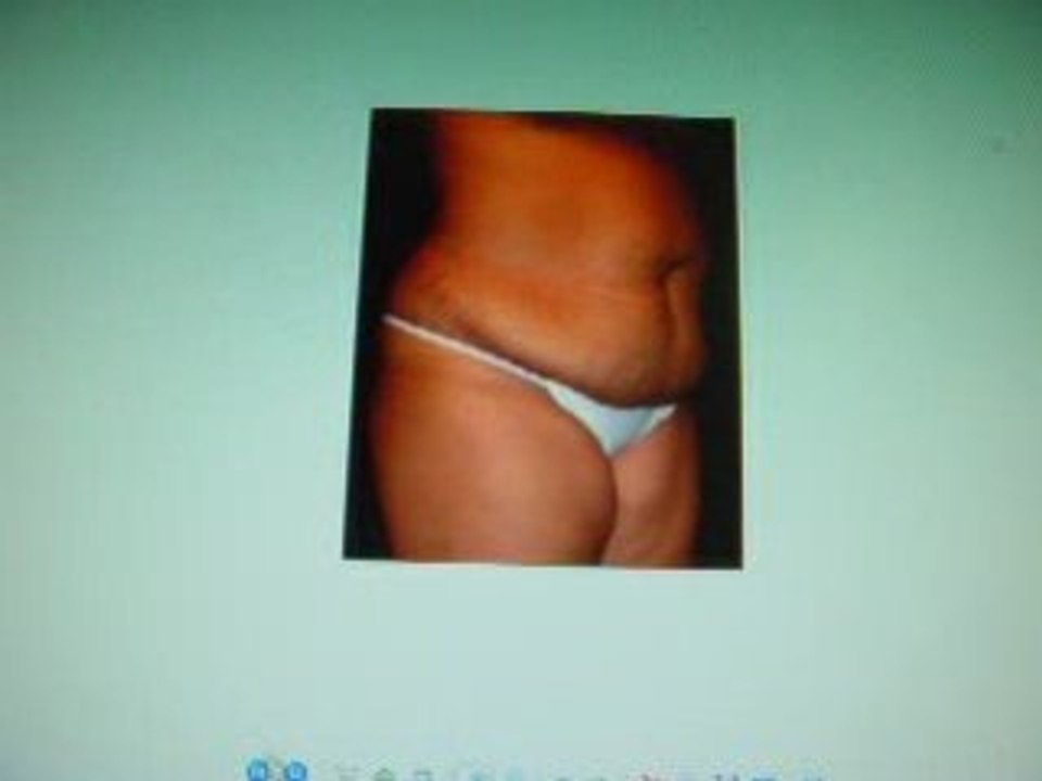 tummy tuck,abdomioplasty,liposuction-qatar-dr. kamal saleh-c