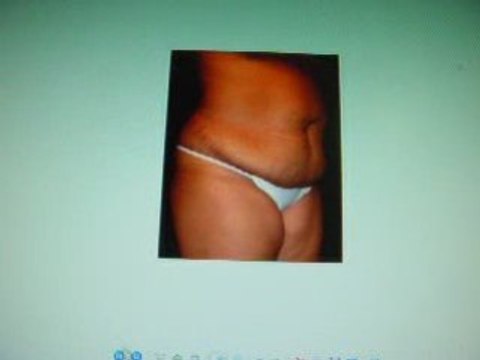 tummy tuck,abdomioplasty,liposuction-qatar-dr. kamal saleh-c