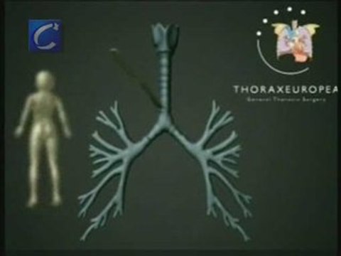 Primer trasplante de tráquea sin posibilidad de rechazo