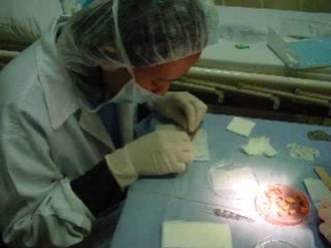 زرع الشعر في قطر دبي-العراق-الطرق الحديثة-hair transplant-qa