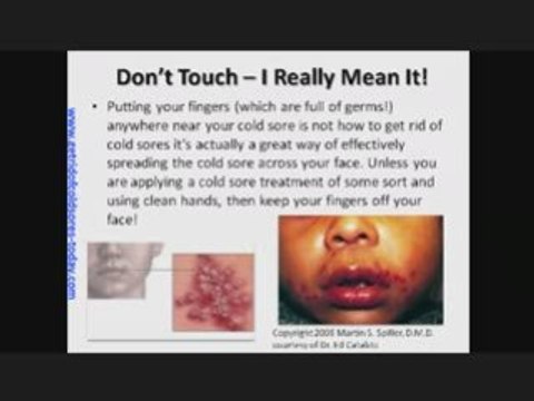 Remedies for Cold Sores Grandmas Sure Fire Remedies for Col