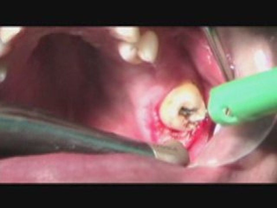 James Experiences The Biolase Waterlase MD due to an Infecte