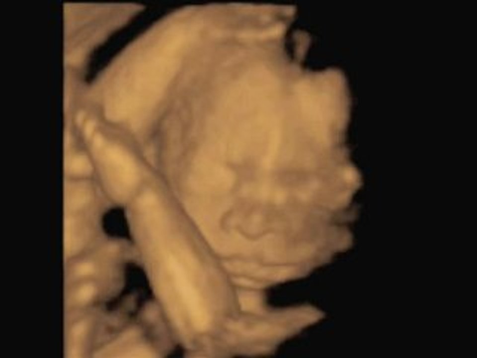 3D Ultrasound
