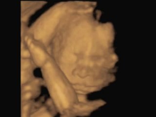 3D Ultrasound