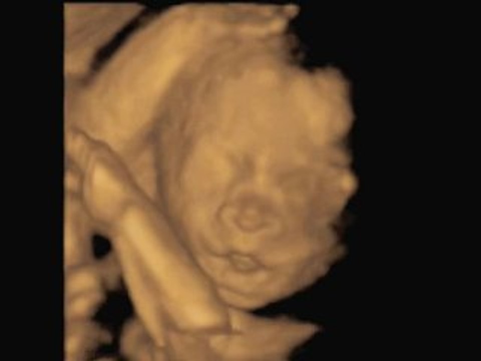 3D Ultrasound (espa
