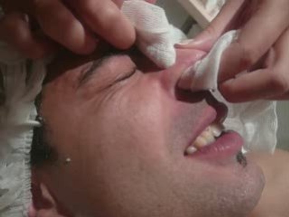 epilation 4
