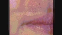 Angular Cheilitis Treatment
