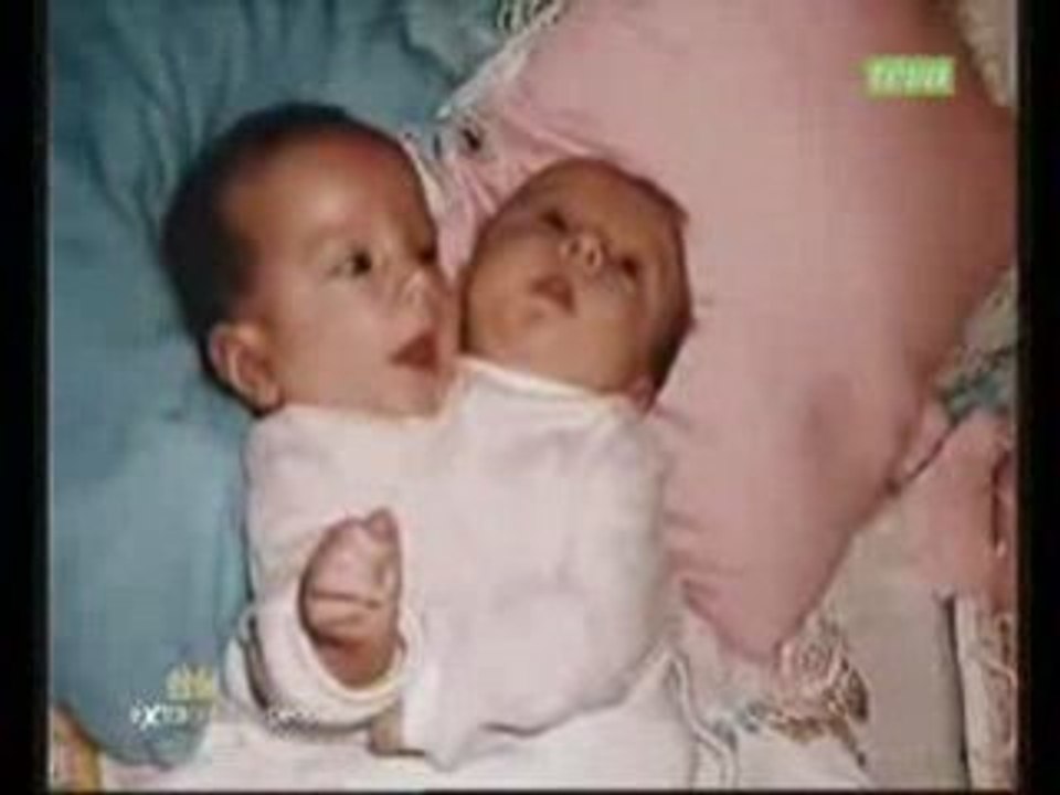 soeurs siamoises 1/5
