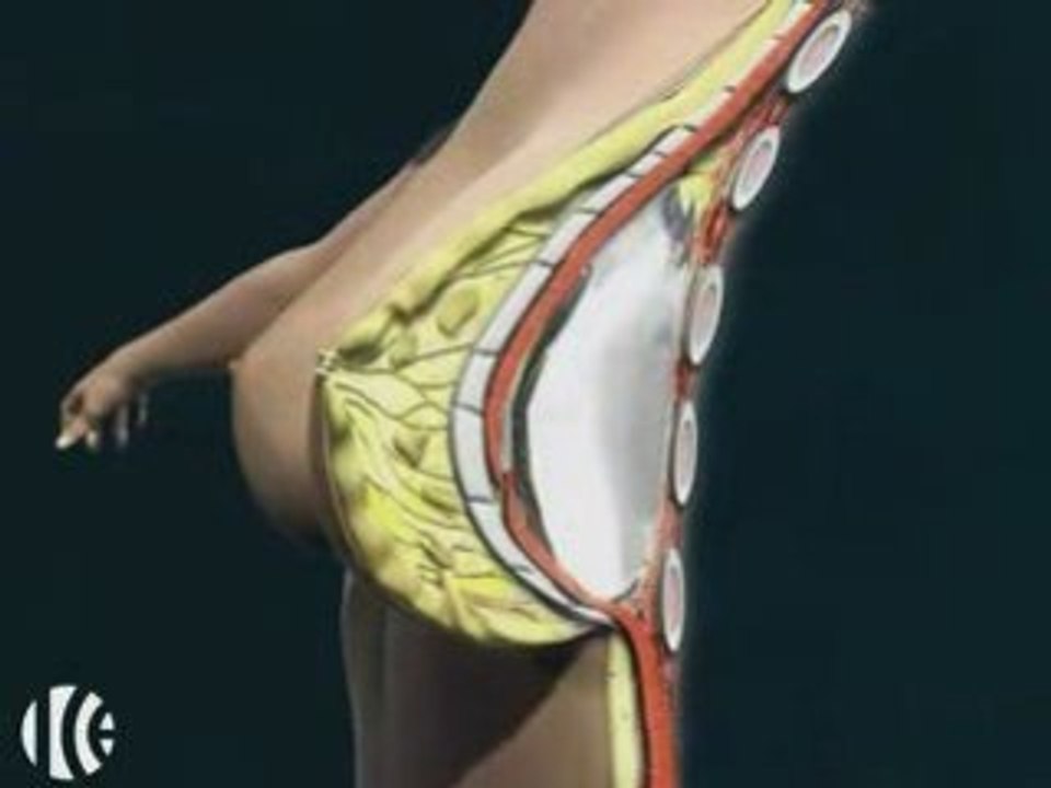Mamoplastia de Aumento - Aumento de Pechos