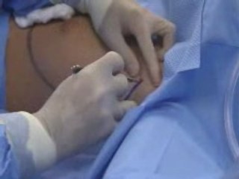 Breast Augmentation Consultation Part I