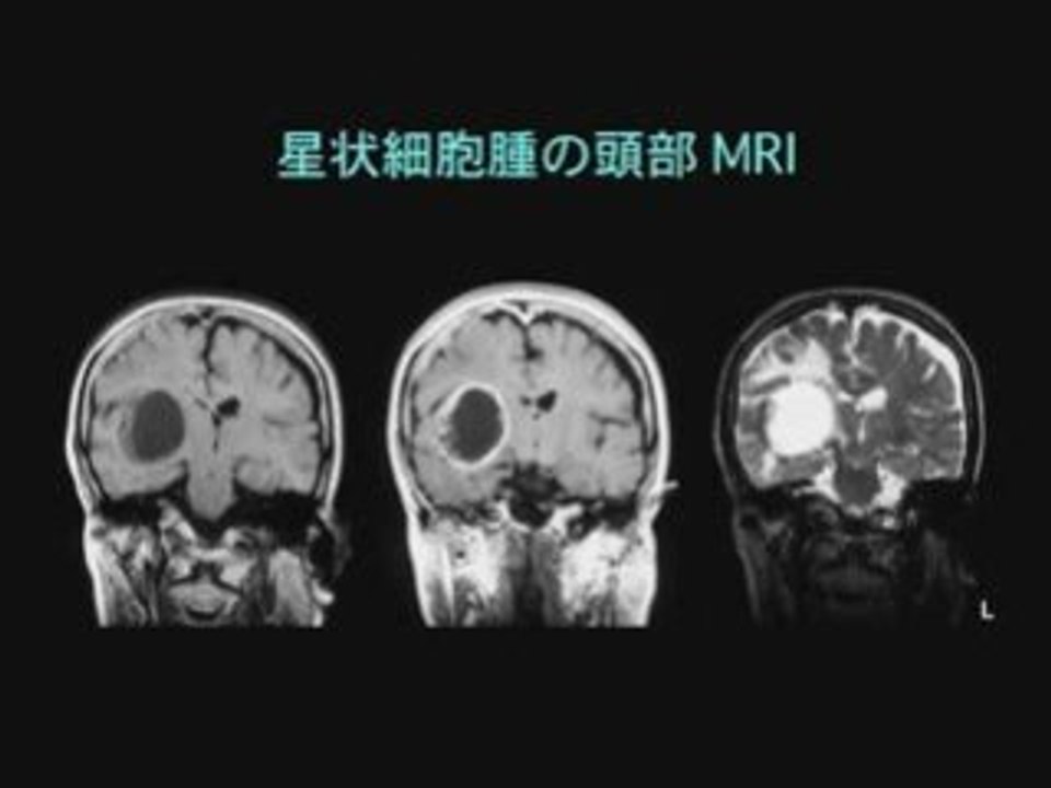 Epilepsy in Japanese