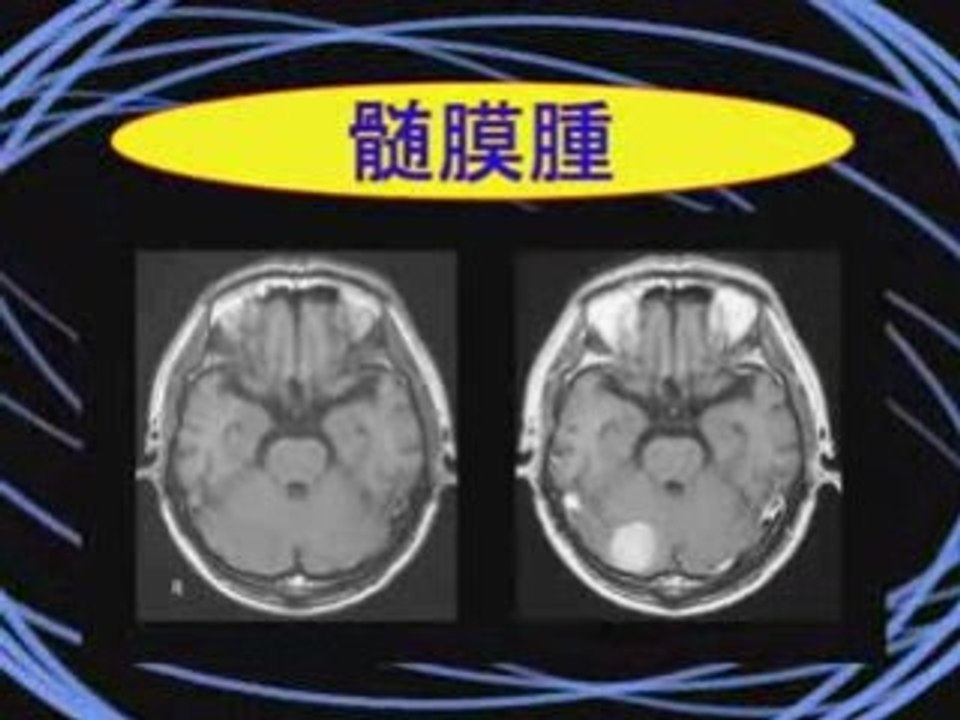 Head MRI in Japanese